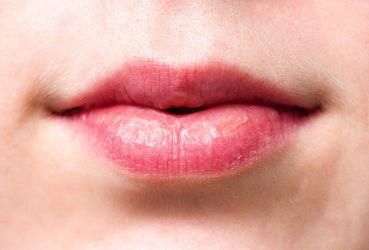 /Wrinkles Above the Lips: The Best Treatments & Prevention